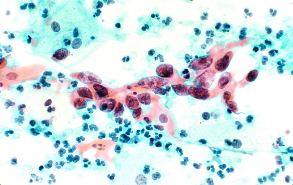 Squamous_cell_carcinoma_in_the_cervix,_pap_stain